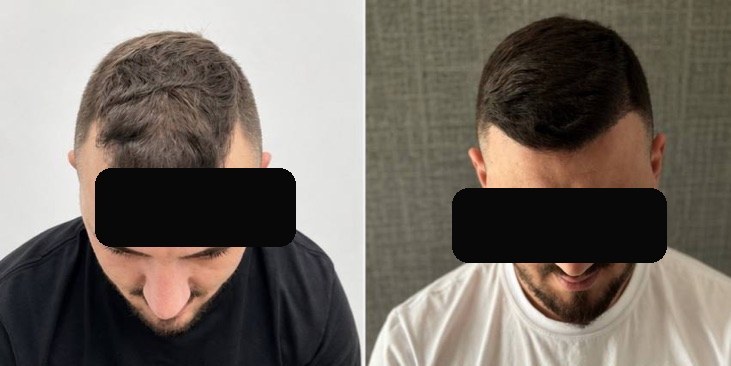 Trapianto di capelli — prima e dopo, caso reale