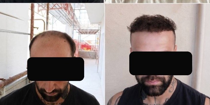Trapianto di capelli — prima e dopo, caso reale