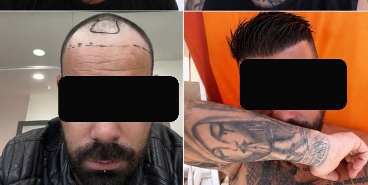 Trapianto di capelli — prima e dopo, caso reale