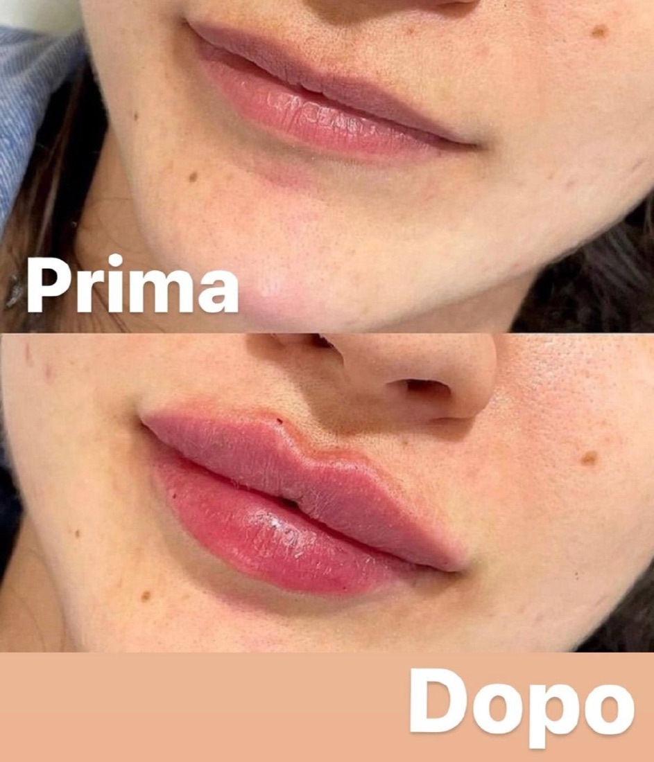 Filler labbra — Prima e Dopo