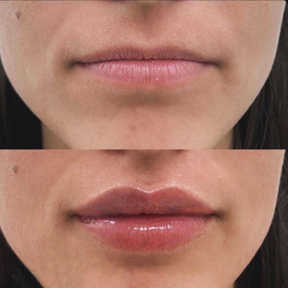 Filler labbra — prima e dopo, caso reale