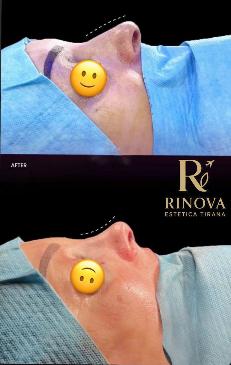 Rinoplastica — confronto clinico perioperatorio